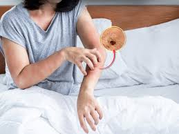 Image result for bedbug bites look like