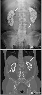 Medullary Nephrocalcinosis Upper Photo Of Conventional Radiograph Of Abdomen And Lower Photo Of Coro Radiology Imaging Radiology Diagnostic Medical Sonography