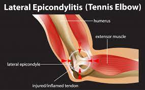Lateral epicondylitis, also known as tennis elbow. Free Vector Lateral Epicondylitis Or Tennis Elbow
