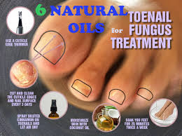 6 natural oils to treat ugly toenail