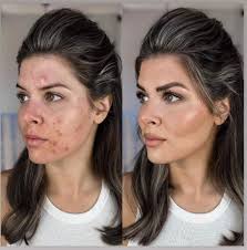 How to cover acne, scarring, and discoloration **Base Face **