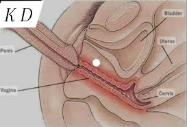 پاره گی پرده بکارت در اثر ورزش و خودارضایی