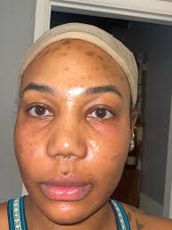 How to get rid of acne scarring due to picking?