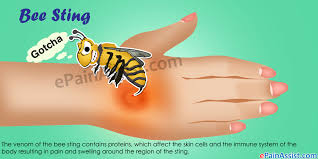 You just might be going or headed into anaphylactic shock. Bee Sting Symptoms Treatment First Aid Home Remedies