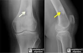Giant Bone Island Frontal And Lateral Knee Radiographs Show A Large Well Circumscribed Ovoid Sclerotic Lesion In The Dist Radiology Imaging Radiology Bones