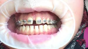 How long will it take to close the gap between my two front teeth with braces? How Long Do Braces Take To Close A 3mm Gap