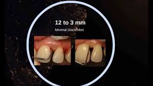 Lanap Laser Gum Surgery Before And After Los Angeles Gum Surgery Gum Graft Surgery