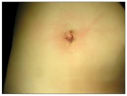 Check spelling or type a new query. Immediate Post Operative Scar After Single Incision Laparoscopic Download Scientific Diagram