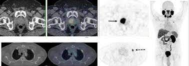 Learn more about msk's approach for surgery, radiation therapy no cancer diagnosis. In Recurrent Prostate Cancer Psma Pet Ct Changes Management In Two Thirds Of Cases