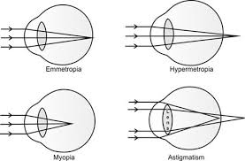 Image result for Refractive Error