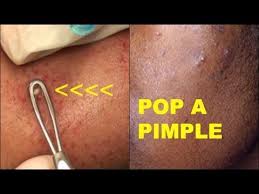 Pop A Pimple Leave No Scar Detailed Tutorial Skincaresunday Poping Pimples Pimples Under The Skin Skin Care Pimples