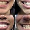 How much does it cost to get a smile at smileshop? Https Encrypted Tbn0 Gstatic Com Images Q Tbn And9gcqzfo9e8plaoj8dmht2sakszu37 Wuw25krfmocwiw Usqp Cau