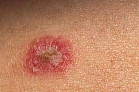 It can look ''mushy,'' says weinberg. Psoriasis Or Ringworm Symptoms Treatment And Other Rashes