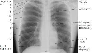 L the portion of the left lung that corresponds anatomically to the right middle lobe is incorporated into the left upper lobe. Intensive Care Nursing Chest X Ray Interpretation Wikiversity