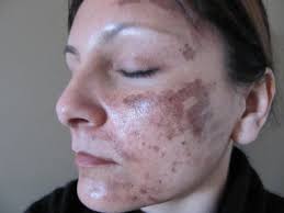 You can greatly reduce the risk of possible side effects by having your. Burns Ipl And Laser Hair Removal A Patient S Guide Updated 2020 Good Skin Days
