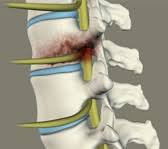 Image result for Spinal Infection