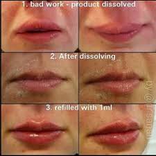 25 Best Lip Fillers Images Lip Fillers Lips Lip Injections