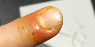 Image result for Akutní zánět nehtového lůžka