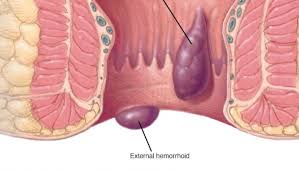 Image result for hemorrhoids