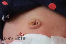 Here's how to care for the umbilical cord stump and your baby's belly button. Baby Umbilical Cord Falling Off What S Normal Kopa Birth