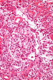 Image result for Acute Pyelonephritis