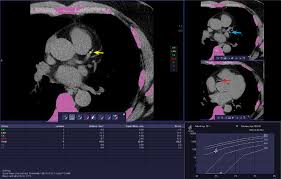 Coronary Artery Calcium Scoring Its Practicality And