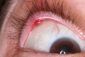 Check spelling or type a new query. Photos Of Chalazion And Stye Eyelid Plastic Surgery