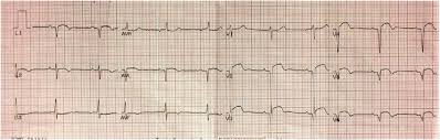 They generally take several hours to develop after an mi, and usually persist indefinitely. Ecg On 2nd Day Showing Pathological Q Waves In Lead I Avl And In V2 V6 Download Scientific Diagram