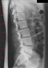 Zaradi dobrega položaja hotel inap prima sri gombak v jame batu / gombak, je to izhodišče zelo primerno za oglede kuala lumpur. Lower Back Pain Spine X Ray Klinik Mediviron Sri Gombak Facebook