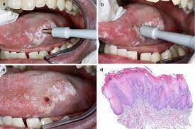 Maybe you would like to learn more about one of these? Examination Of The Oral Cavity Referral To A Specialist And The Biopsy Procedure Springerlink