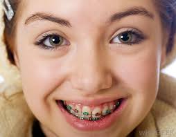 Usually in children, the overbite is treated through removal of baby teeth, braces, retainers and growth modification devices. What Is A Crossbite With Pictures