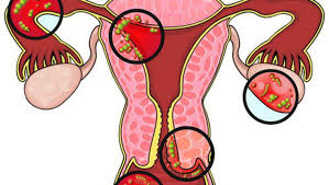 More than 95% of endometrial cancer happens in. Endometrial Cancer Signs And Symptoms Everything You Need To Know About The Sixth Most Common Type Of Cancer In Women