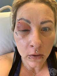 Hairdresser Nearly Lost Her Eye After Hair Splinter Caused Infection Media Drum World