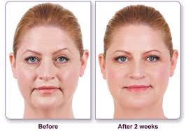 They stretch from the bottom of your nose to the corners of your mouth. Juvederm May Help Correct Your Nasolabial Folds Without Surgery