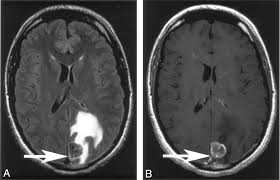 Image result for Brain Lesion