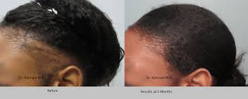 She was recently honored in md news, a national publication, for addressing disparities in health care. African American Hair Transplants By Dr Sean Behnam