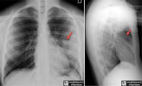 Image result for Pulmonary Contusion