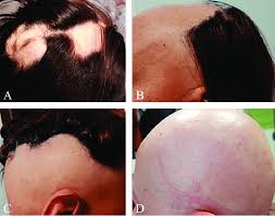 Classification of the types of androgenetic alopecia (common baldness) occurring in the female sex. Clinical Types Of Alopecia Areata A Patchy Alopecia B Sisaipho Download Scientific Diagram
