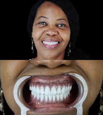 Before and After Dental Work in Mexico