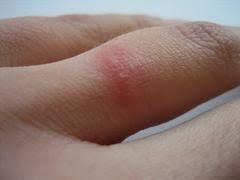Allergic Reaction To Wedding Ring After Years In 2020 Affordable Wedding Ring Wedding Ring Rash Buy Wedding Rings