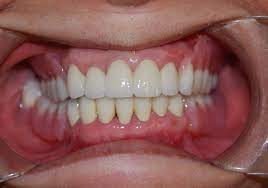 Upper denture in the hands of a dentist. Dentures 19th Avenue Dental