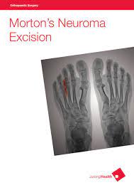 Orthopaedics Surgery Morton S Neuroma Excision By Juronghealth Campus Issuu