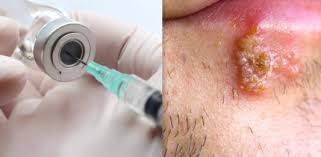 Image result for human papillomavirus symptoms