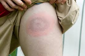 Plus de 50 % des patients ayant eu un erytheme migrant non traité feront de l'arthrite (genoux++), environ 10 % auront une maladie neurologique. Lyme Des Bacteries Toujours Vivantes Malgre Les Antibiotiques