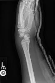 Image result for Lunate Dislocation