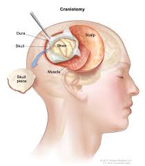 Those that grow in infants and children are very different from those in adults. Adult Central Nervous System Tumors Treatment Pdq Patient Version National Cancer Institute