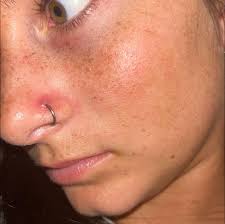 Nose piercing bump removal advice needed