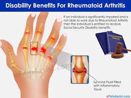 What Does Rheumatoid Arthritis Look Like Check More At Http Www Nhprimecare Org What Does Rheumatoid Arthritis Look Like