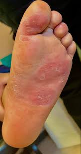 Image result for dermatitis contacta