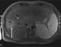 Image result for Liver Abscess